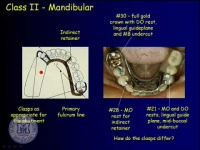 Removable Partial Design & Full Dentures Package