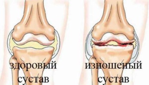 Почему хрустят колени?