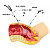 Лапароскопия