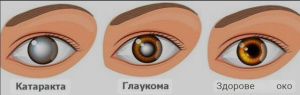 Глаукома ока